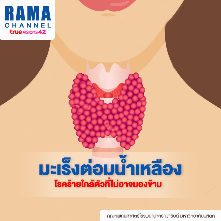 มะเร็งต่อมน้ำเหลือง โรคร้าย