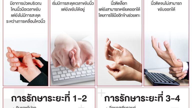4 ระยะความรุนแรงของนิ้วล็อก-01