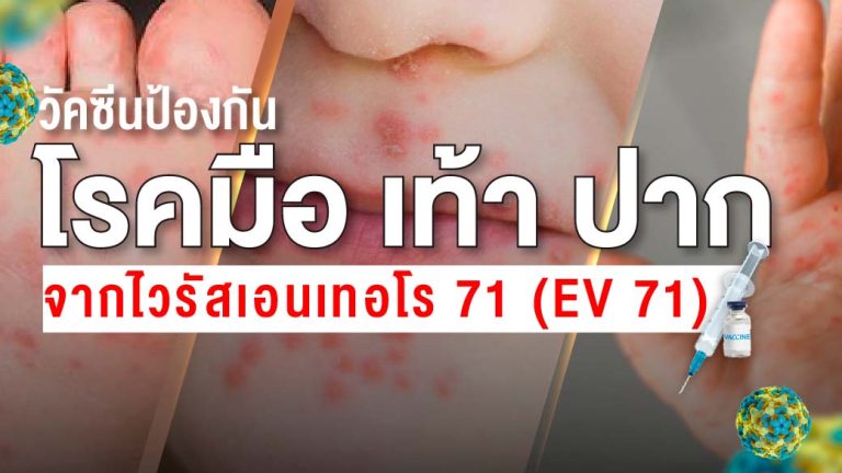 วัคซีนป้องกันโรคมือเท้าปาก EV71