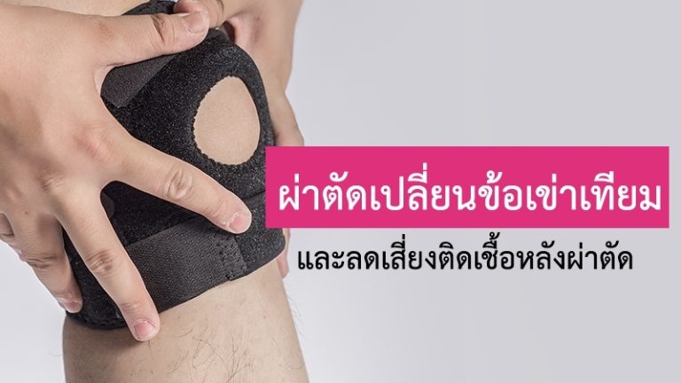 ผ่าตัดข้อเข่า